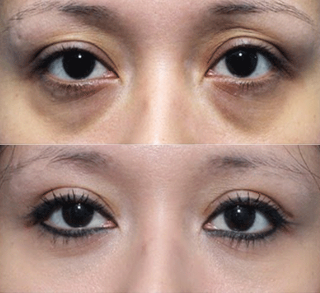 Eye Package (Save: $700)